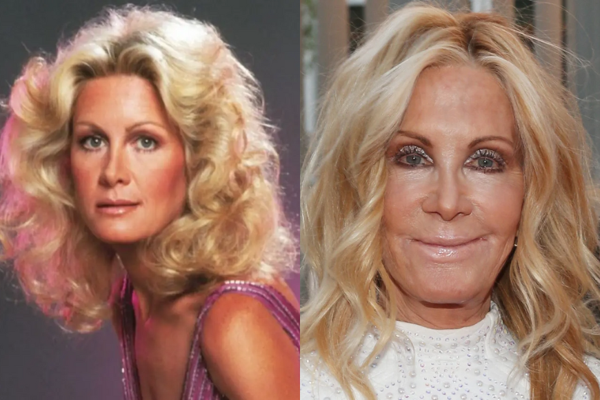 10 Celebs Who Ruined Their Faces Through Plastic Surgery